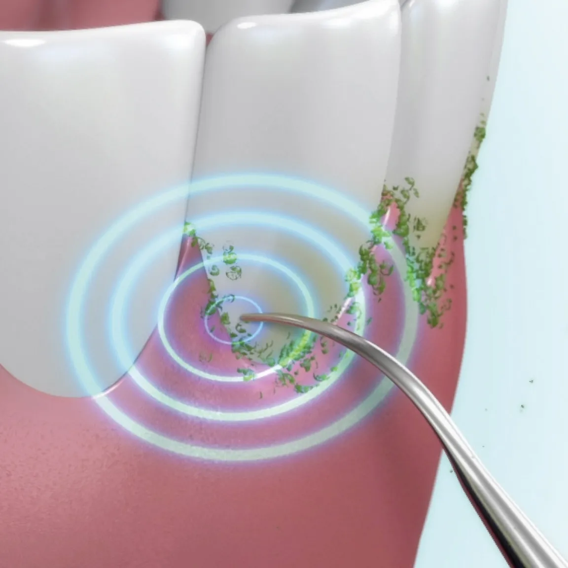 Hot Tempsl Détartreur ultrasons